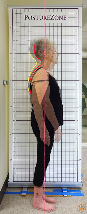A woman stands in front of a line graph, determining the curvature of her spine.